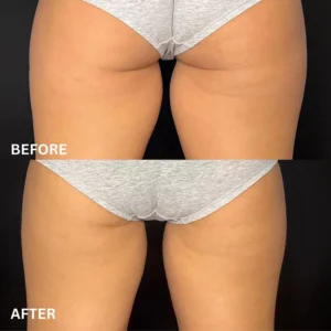 Thigh Slimming Effect