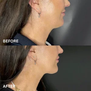 Jaw Line Lifting Effect