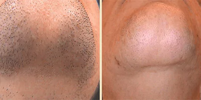 laser-hair-removal-by-beauty-device-before-after-2.webp