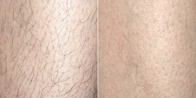laser-hair-removal-by-beauty-device-before-after-3.webp