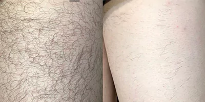 laser-hair-removal-by-beauty-device-before-after-5.webp