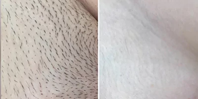 laser-hair-removal-by-beauty-device-before-after-7.webp