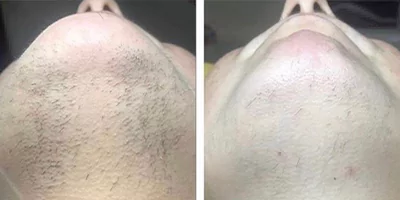 laser-hair-removal-by-beauty-device-before-after-8.webp