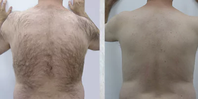 laser-hair-removal-by-beauty-device-before-after-9.webp